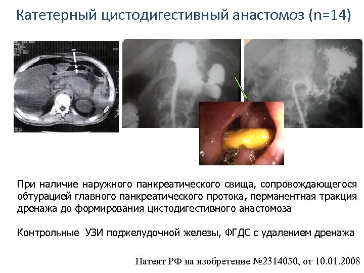 Катетерный цистодигестивный анастомоз (n=14) При наличие наружного панкреатического свища, сопровождающегося обтурацией главного панкреатического протока,