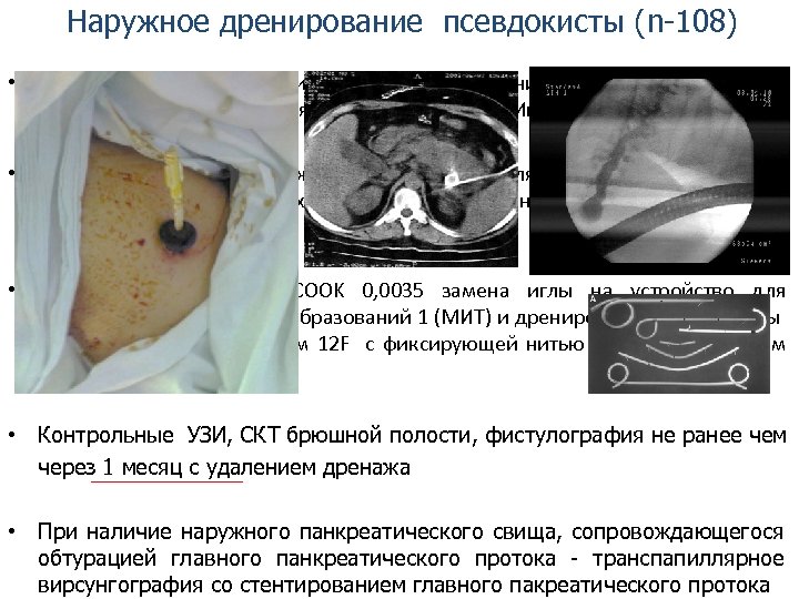 Наружное дренирование псевдокисты (n-108) • Прицельная пункция жидкостного образования под ультразвуковым наведением проходя минуя