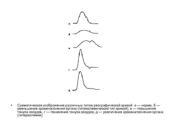  • Схематическое изображение различных типов реографической кривой: а — норма, б — уменьшение