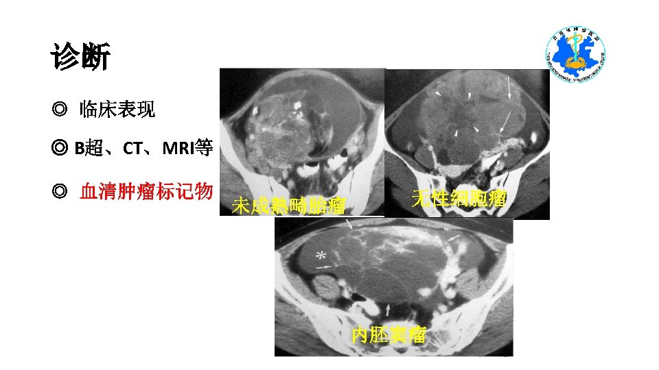 诊断 ◎ 临床表现 ◎ B超、CT、MRI等 ◎ 血清肿瘤标记物 未成熟畸胎瘤 无性细胞瘤 内胚窦瘤 