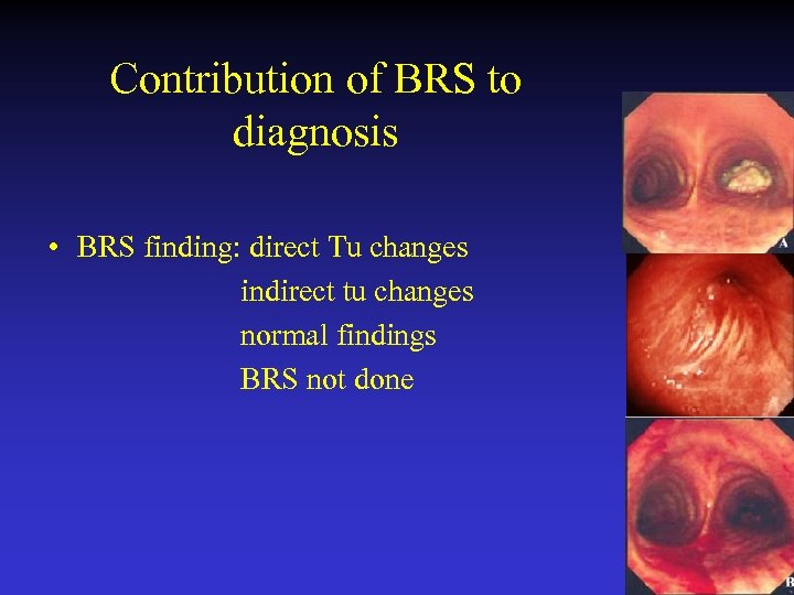 Contribution of BRS to diagnosis • BRS finding: direct Tu changes indirect tu changes