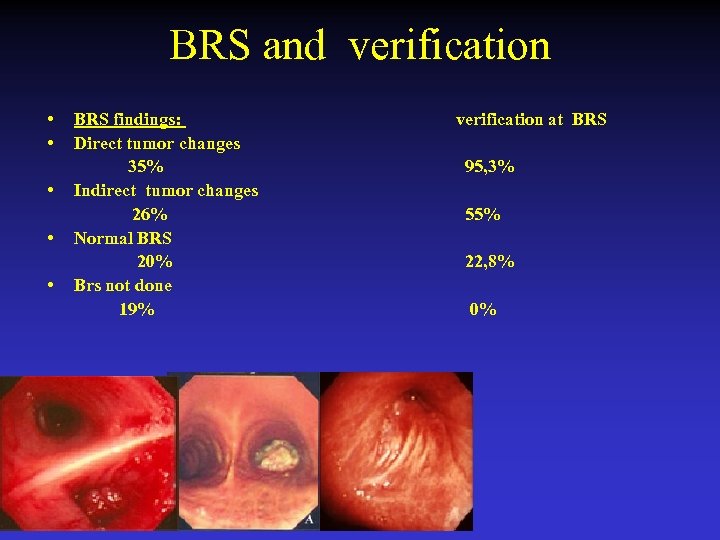 BRS and verification • • • BRS findings: Direct tumor changes 35% Indirect tumor