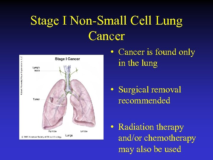 Stage I Non-Small Cell Lung Cancer • Cancer is found only in the lung