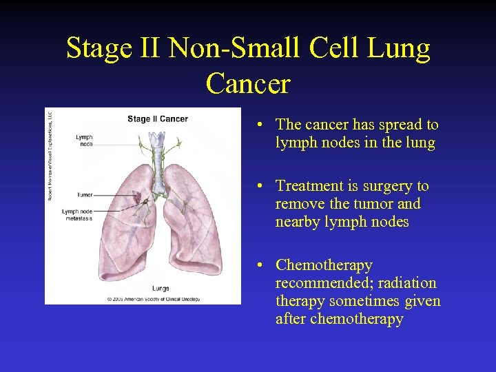 Stage II Non-Small Cell Lung Cancer • The cancer has spread to lymph nodes