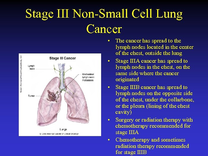 Stage III Non-Small Cell Lung Cancer • The cancer has spread to the lymph