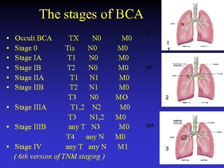  The stages of BCA • Occult BCA TX N 0 M 0 •