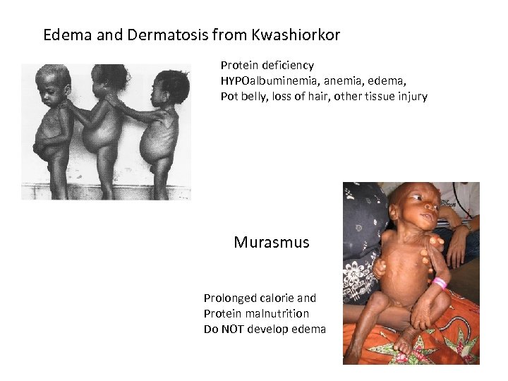 Edema and Dermatosis from Kwashiorkor Protein deficiency HYPOalbuminemia, anemia, edema, Pot belly, loss of