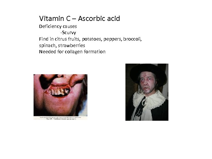 Vitamin C – Ascorbic acid Deficiency causes -Scurvy Find in citrus fruits, potatoes, peppers,
