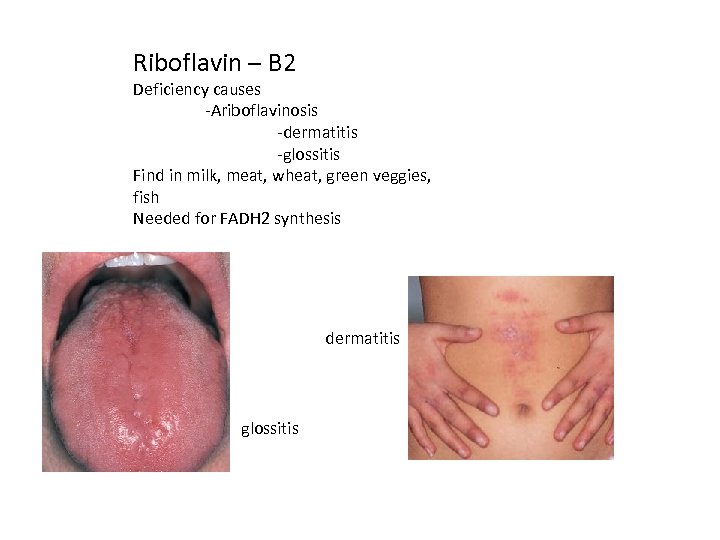 Riboflavin – B 2 Deficiency causes -Ariboflavinosis -dermatitis -glossitis Find in milk, meat, wheat,
