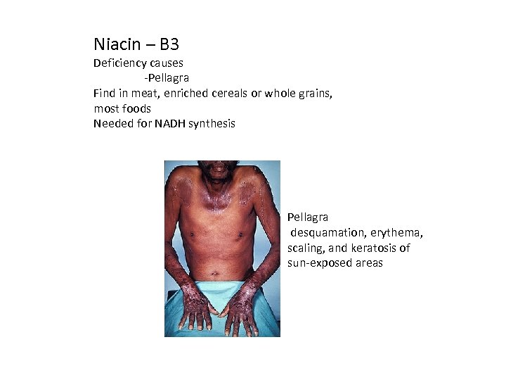 Niacin – B 3 Deficiency causes -Pellagra Find in meat, enriched cereals or whole