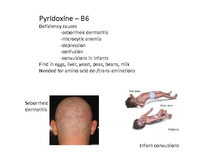 Pyridoxine – B 6 Deficiency causes -seborrheic dermatitis -microcytic anemia -depression -confusion -convulsions in