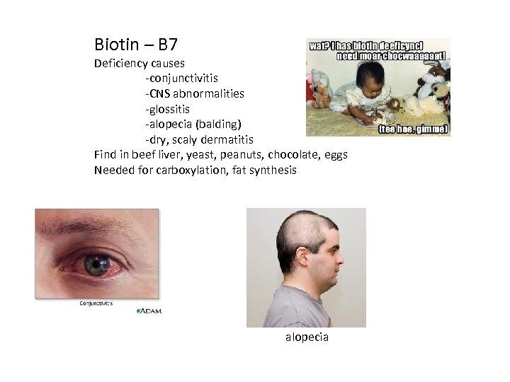 Biotin – B 7 Deficiency causes -conjunctivitis -CNS abnormalities -glossitis -alopecia (balding) -dry, scaly