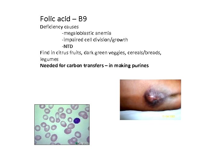 Folic acid – B 9 Deficiency causes -megaloblastic anemia -impaired cell division/growth -NTD Find