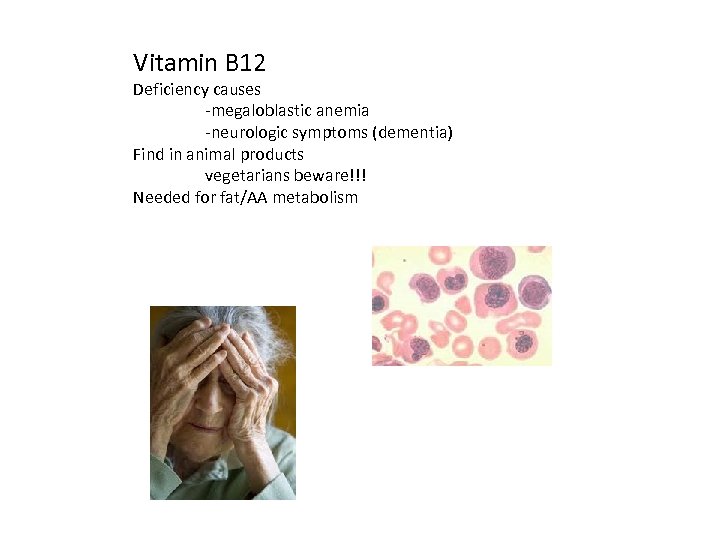 Vitamin B 12 Deficiency causes -megaloblastic anemia -neurologic symptoms (dementia) Find in animal products