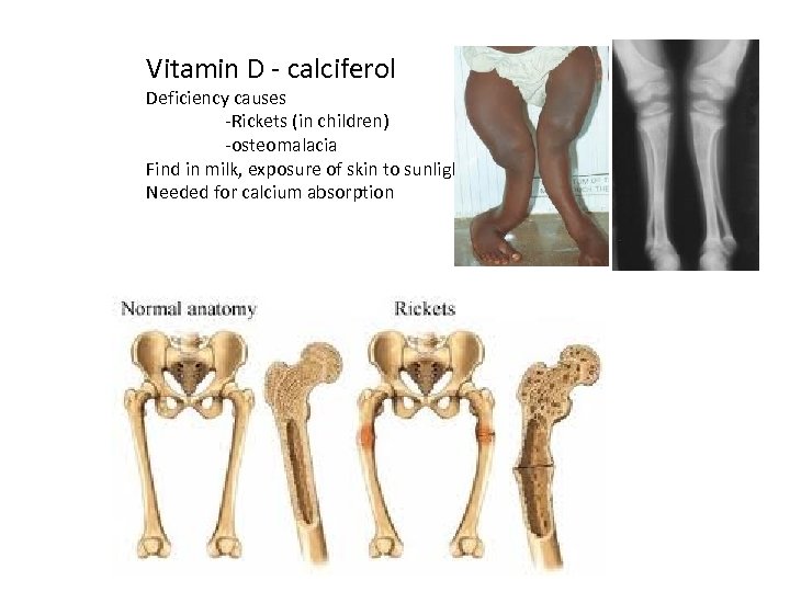 Vitamin D - calciferol Deficiency causes -Rickets (in children) -osteomalacia Find in milk, exposure