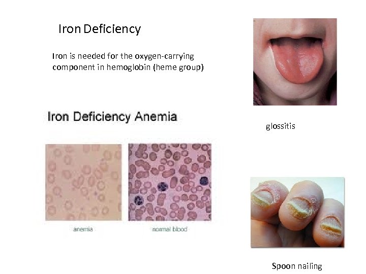 Iron Deficiency Iron is needed for the oxygen-carrying component in hemoglobin (heme group) glossitis