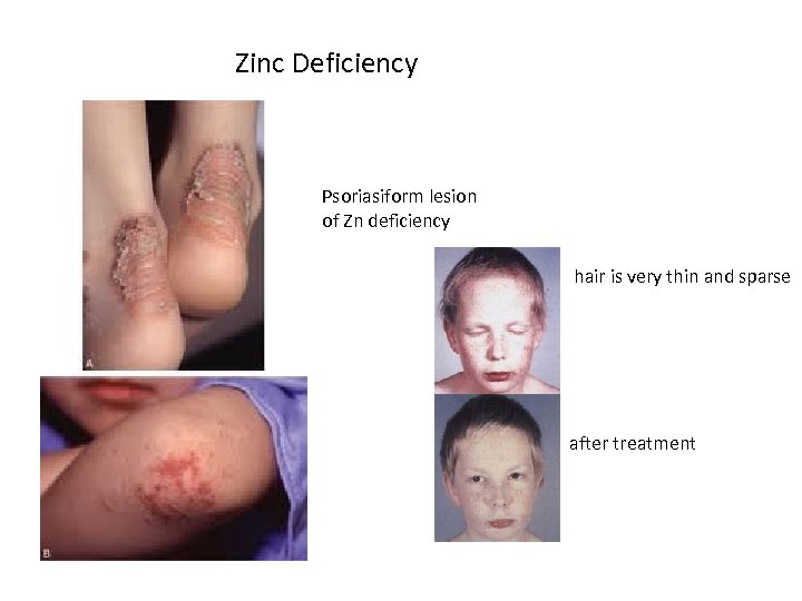 Zinc Deficiency Psoriasiform lesion of Zn deficiency hair is very thin and sparse after