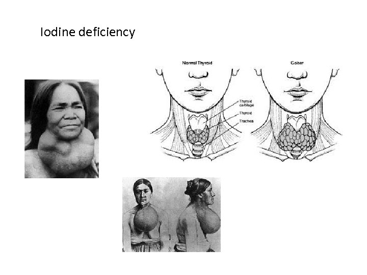 Iodine deficiency 