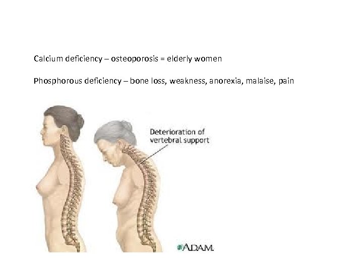 Calcium deficiency – osteoporosis = elderly women Phosphorous deficiency – bone loss, weakness, anorexia,