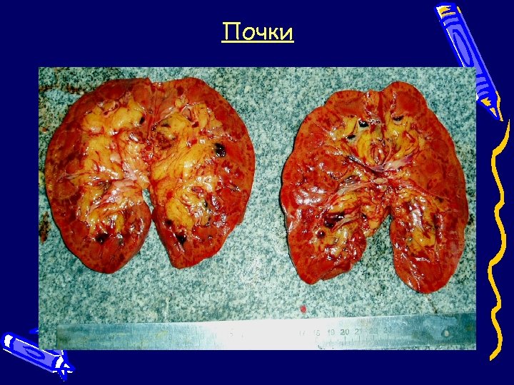 Почки 