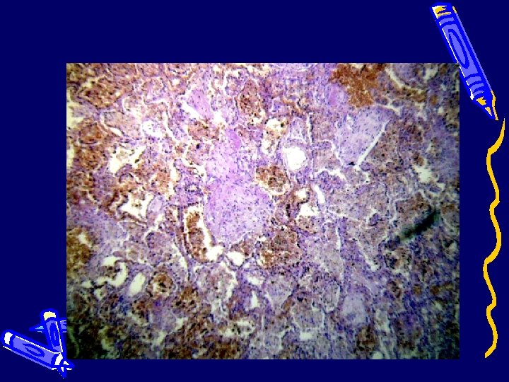 Легкие (смешанная пневмония) 