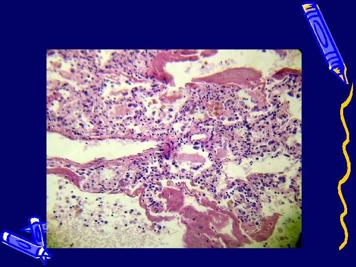 Легкие (гиалиновые мембраны) 