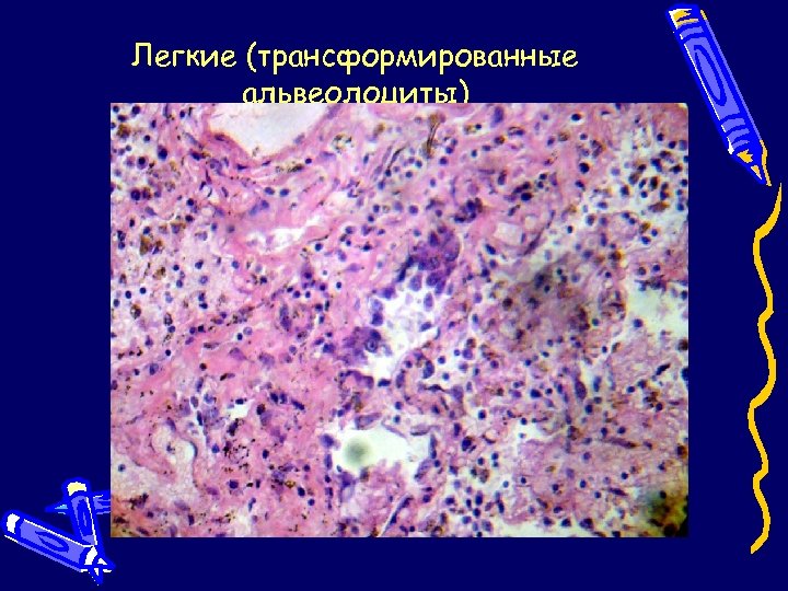 Легкие (трансформированные альвеолоциты) 