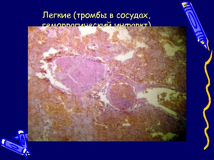 Легкие (тромбы в сосудах, геморрагический инфаркт) 