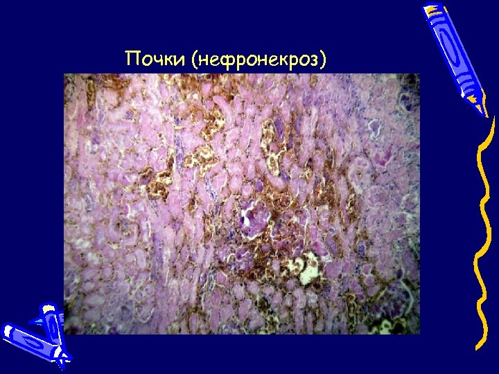 Почки (нефронекроз) 