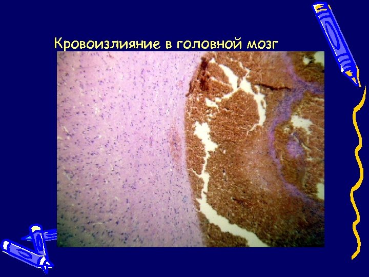 Кровоизлияние в головной мозг 