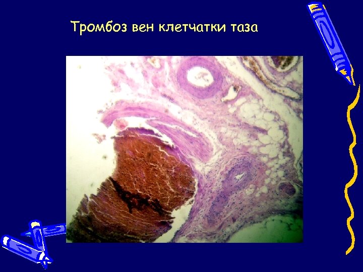 Тромбоз вен клетчатки таза 