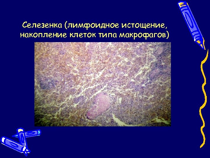 Селезенка (лимфоидное истощение, накопление клеток типа макрофагов) 