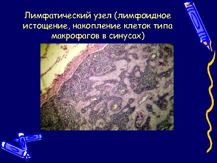 Лимфатический узел (лимфоидное истощение, накопление клеток типа макрофагов в синусах) 