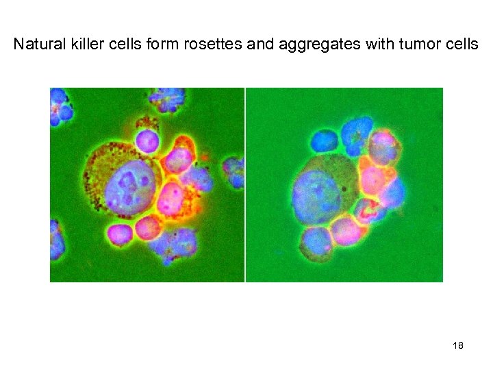 Natural killer cells form rosettes and aggregates with tumor cells 18 