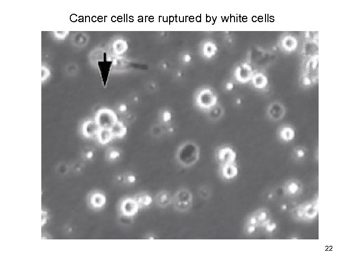 Cancer cells are ruptured by white cells Mixed pop-rosettes 22 