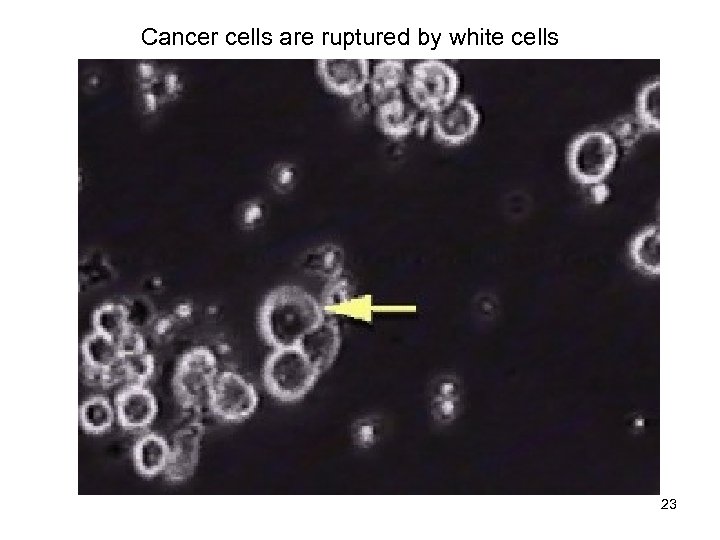 Cancer cells are ruptured by white cells Mixed pop 23 