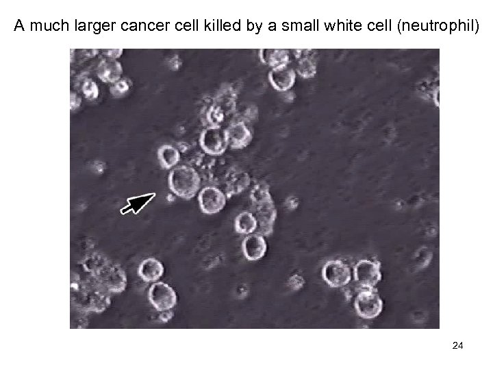 A much larger cancer cell killed by a small white cell (neutrophil) Pmn-apop 24