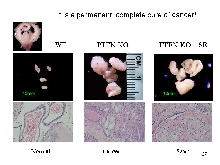 It is a permanent, complete cure of cancer! WT Normal PTEN-KO + SR Cancer