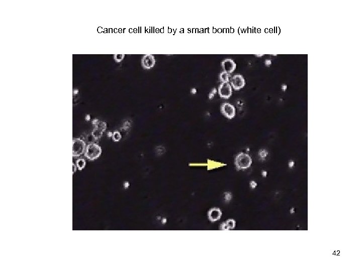 Cancer cell killed by a smart bomb (white cell) 42 