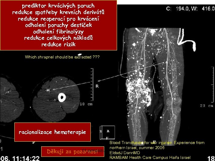 prediktor krvácivých poruch redukce spotřeby krevních derivátů redukce reoperací pro krvácení odhalení poruchy destiček