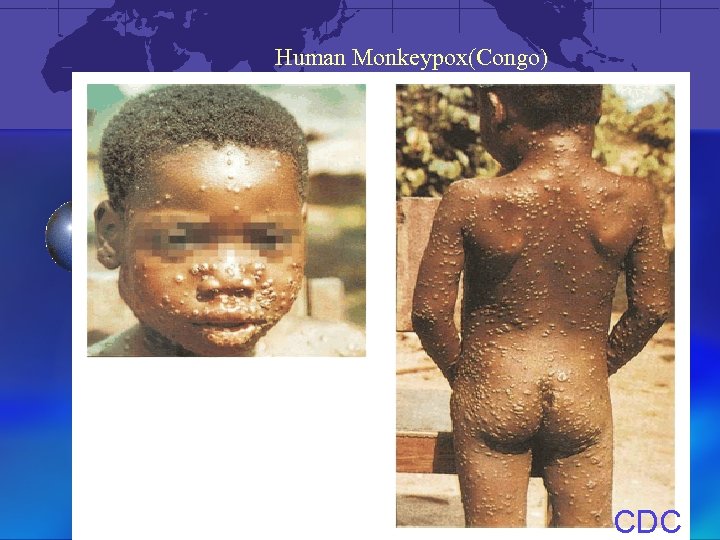 Human Monkeypox(Congo) CDC 