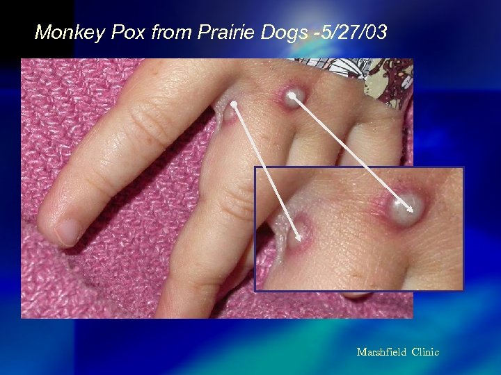 Monkey Pox from Prairie Dogs -5/27/03 Marshfield Clinic 