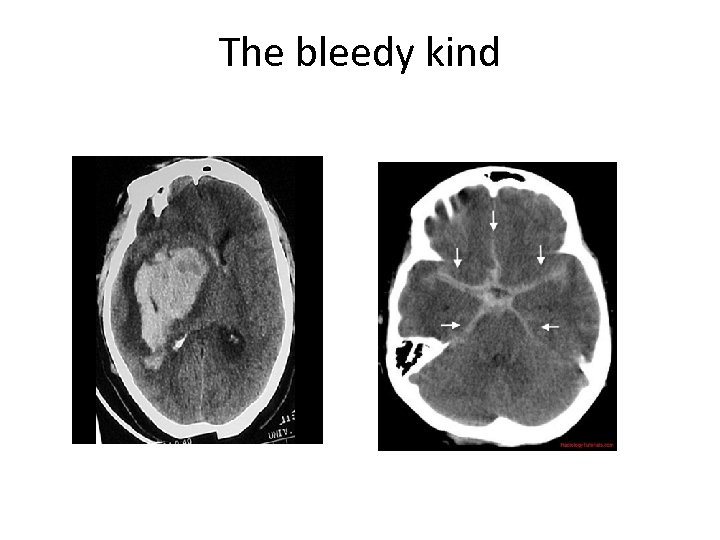 The bleedy kind 