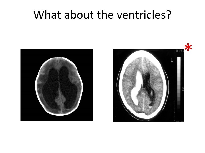 What about the ventricles? * 
