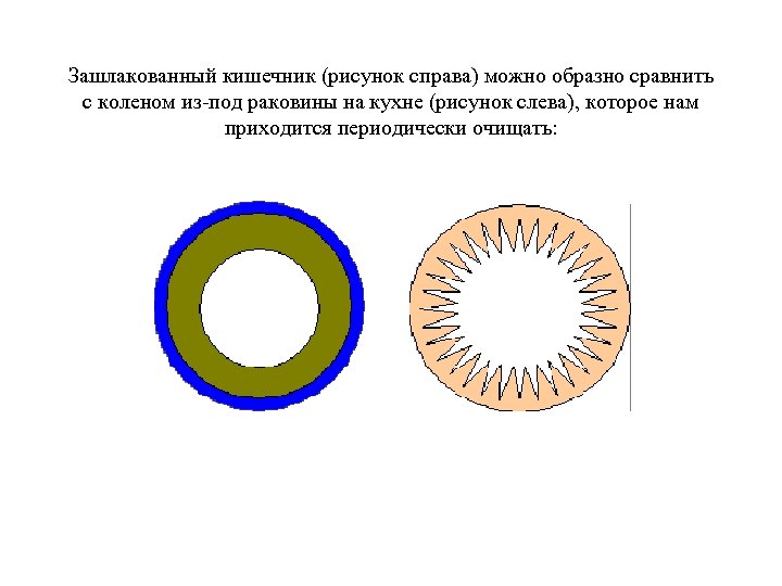 Зашлакованный кишечник (рисунок справа) можно образно сравнить с коленом из-под раковины на кухне (рисунок