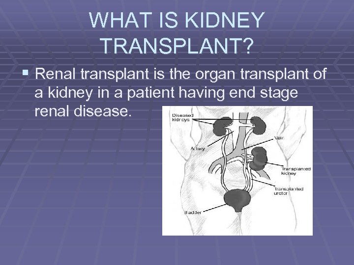 WHAT IS KIDNEY TRANSPLANT? § Renal transplant is the organ transplant of a kidney