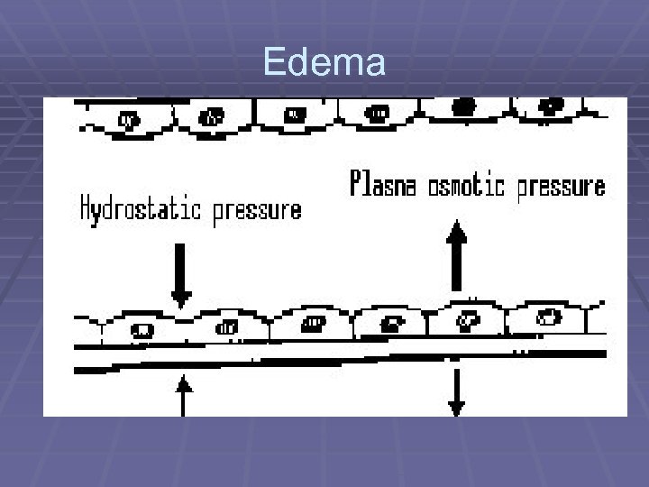 Edema 