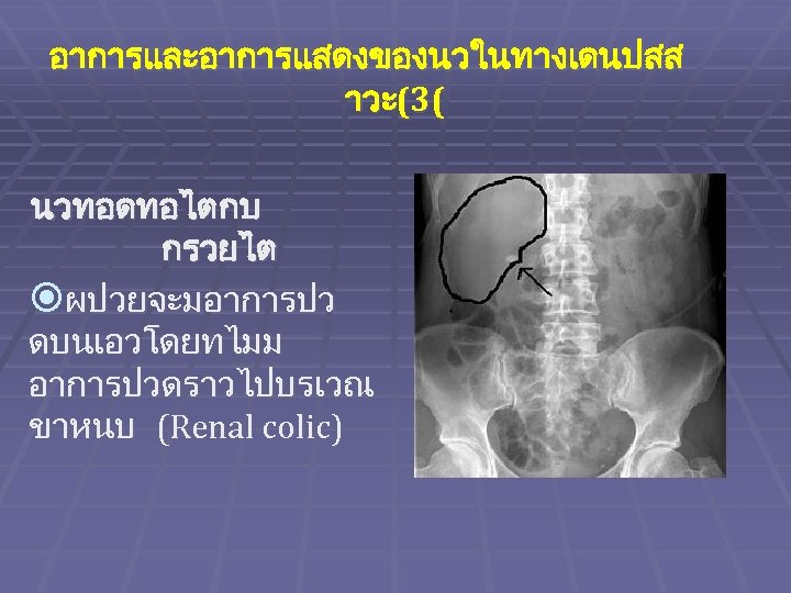 อาการและอาการแสดงของนวในทางเดนปสส าวะ(3( นวทอดทอไตกบ กรวยไต ผปวยจะมอาการปว ดบนเอวโดยทไมม อาการปวดราวไปบรเวณ ขาหนบ (Renal colic) 