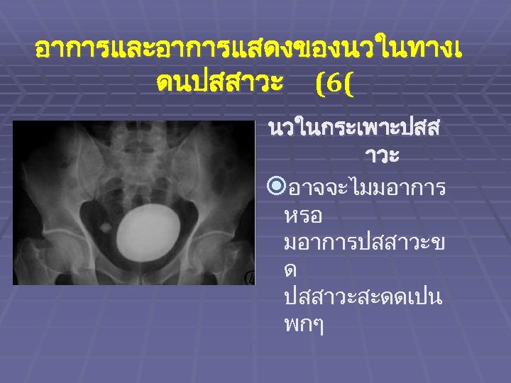 อาการและอาการแสดงของนวในทางเ ดนปสสาวะ (6( นวในกระเพาะปสส าวะ อาจจะไมมอาการ หรอ มอาการปสสาวะข ด ปสสาวะสะดดเปน พกๆ 