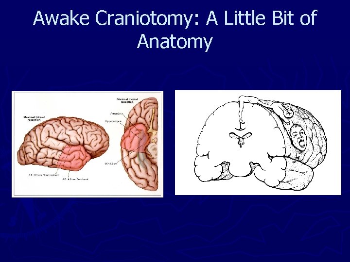 Awake Craniotomy: A Little Bit of Anatomy 